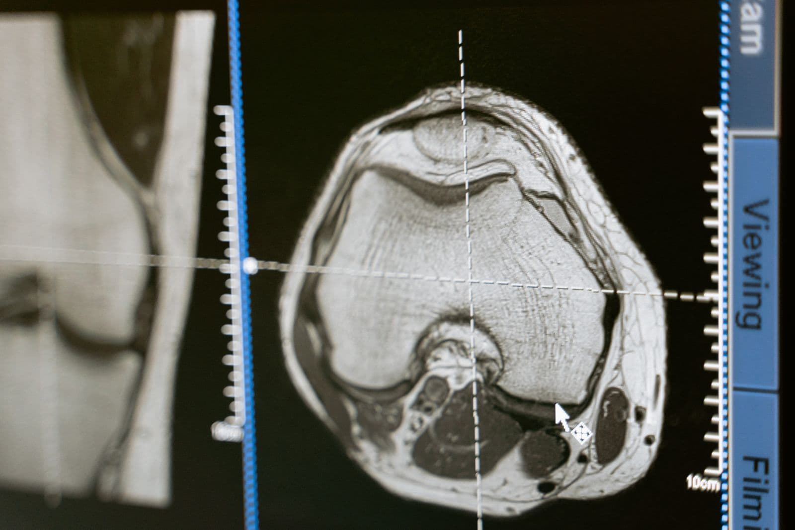 A brain MRI scan displayed on a medical monitor