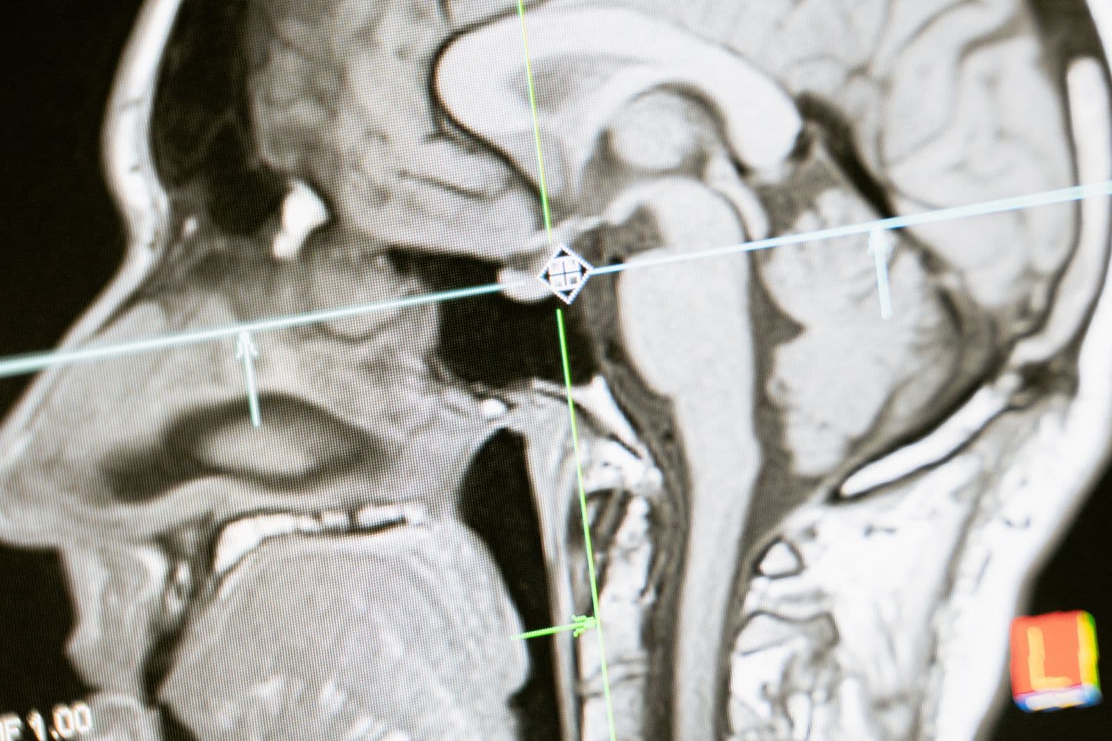 A sagittal MRI scan of the human brain displayed for review