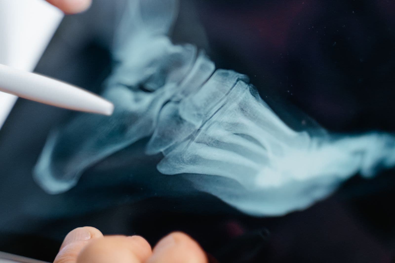 A foot X-ray displayed in close-up on a digital tablet
