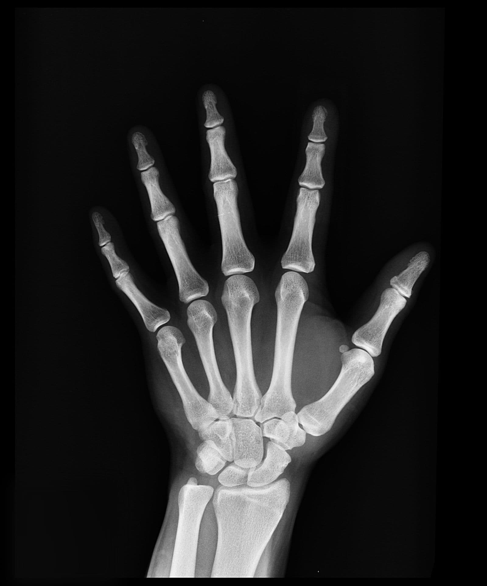 An X-ray showing the bones and joints of a human hand